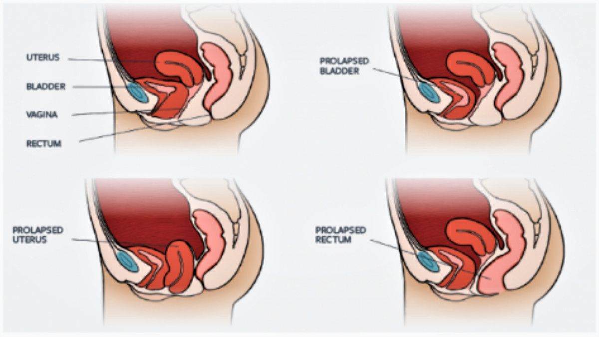 Prolaps Organ Panggul, Masalah Setelah Melahirkan