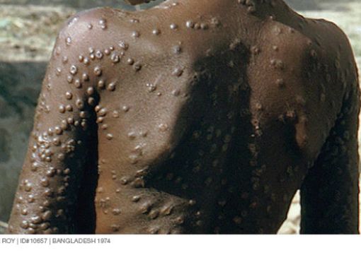 5 Penyakit Selain Cacar Monyet yang Ditularkan Hewan ke Manusia