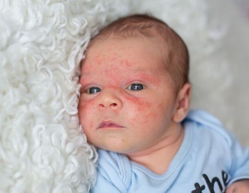 7 Cara Mengobati Eksim pada Anak