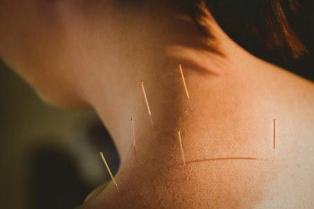 Akupunktur untuk Nyeri Leher