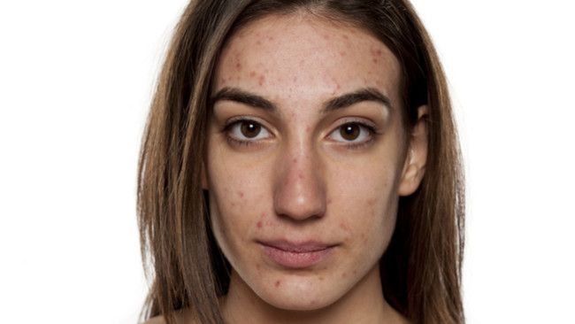 Kebiasaan Mandi seperti Ini Bisa Bikin Anda Jerawatan