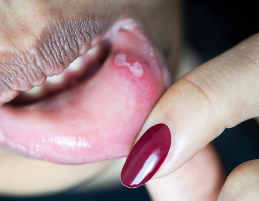 Heran, Mengapa Sariawan Muncul Setelah Cabut Gigi?