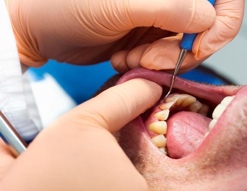 3 Penyakit Berbahaya di Balik Gusi Berdarah