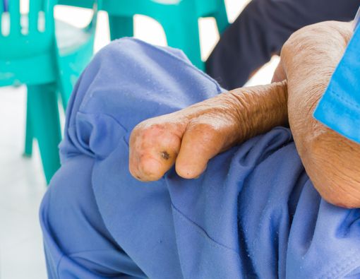 Komplikasi yang Sering Dialami Penderita Penyakit Kusta