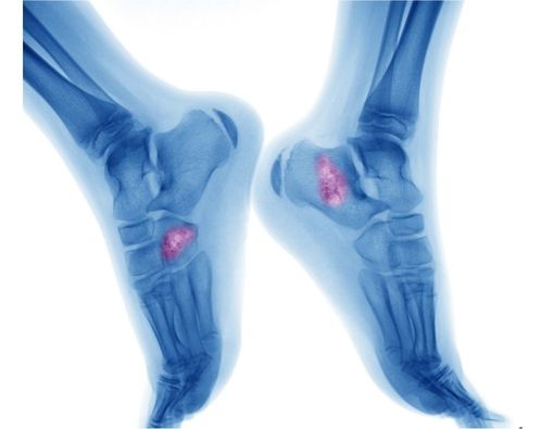 Nutrisi yang Baik Untuk Pasien Osteosarkoma