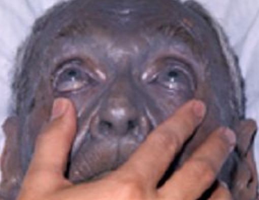 Argyria, Penyakit yang Bikin Kulit Berwarna Biru Keabu-Abuan