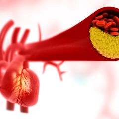 5 Makanan untuk Menghindari Penyumbatan Arteri