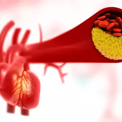 5 Makanan untuk Menghindari Penyumbatan Arteri