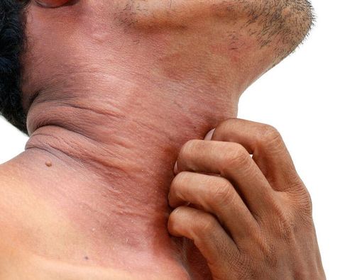 Korengan Akibat Darah Manis, Mitos Atau Fakta?