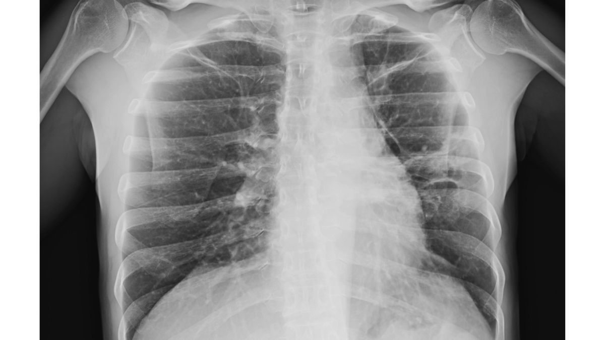 Mengenal Penyebab dan Pengobatan Granuloma Paru