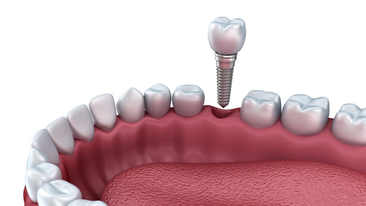 Implan di Bidang Kedokteran Gigi