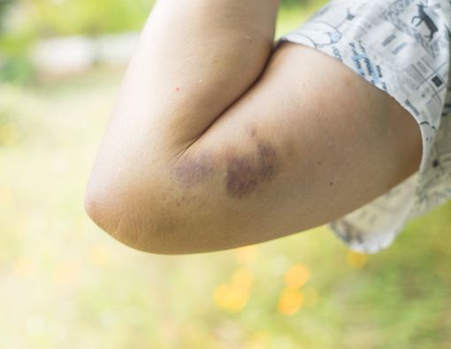 Inilah Penyebab Munculnya Bercak Biru di Kulit