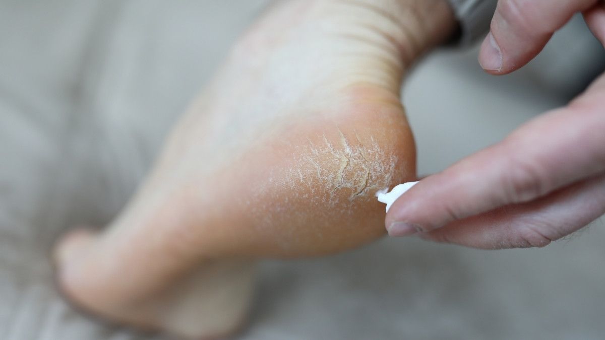 Tumit Pecah-Pecah, Atasi dengan Cara Ini