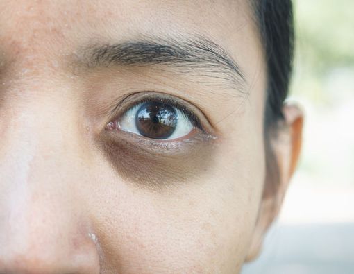 5 Cara Mudah Atasi Mata Panda