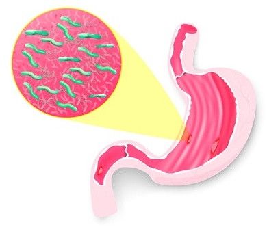 Tukak Lambung, Bukan Sakit Maag?