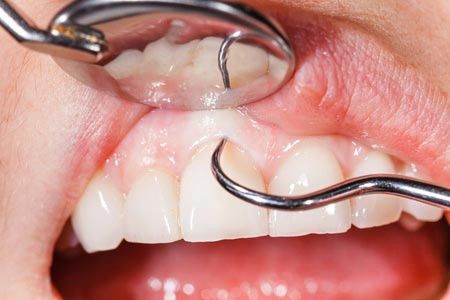 5 Tanda Kerusakan Pada Jaringan Pendukung Gigi