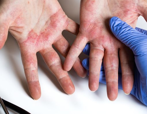 4 Penyebab Telapak Tangan Gatal dan Muncul Bintik Berair