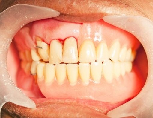 Mengenal Periodontitis