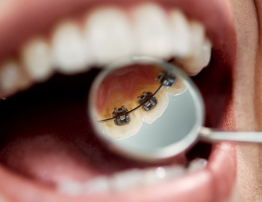 Mengenal Kawat Gigi Lingual dan Fungsinya