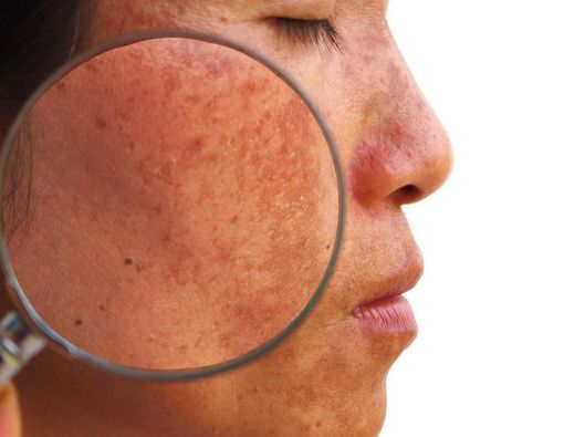 Benarkah Melasma Bisa Memicu Kanker Kulit?