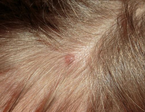 5 Penyebab Munculnya Bisul di Kepala dan Cara Mengatasinya