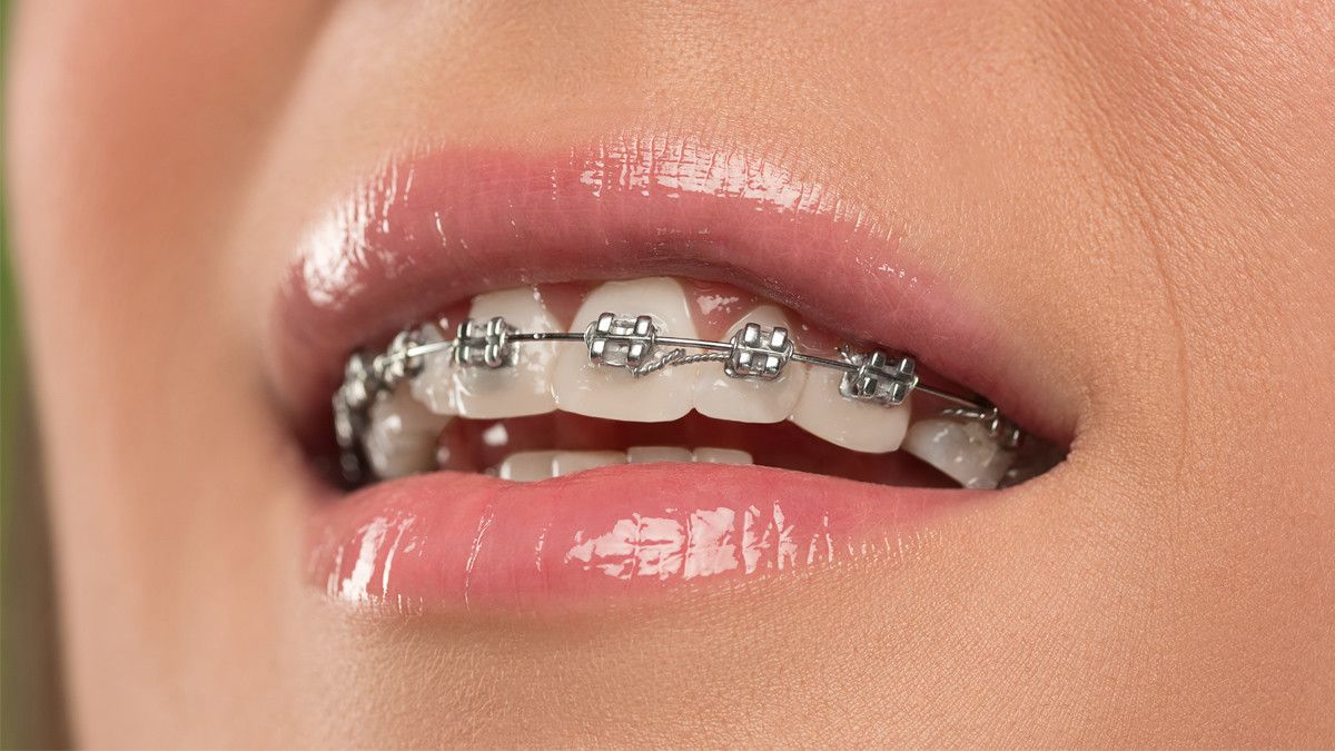 Tips Atasi Nyeri Saat Behel Dikencangkan