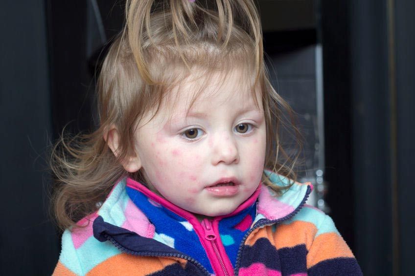 Cara Mengatasi Ruam Merah pada Kulit Anak