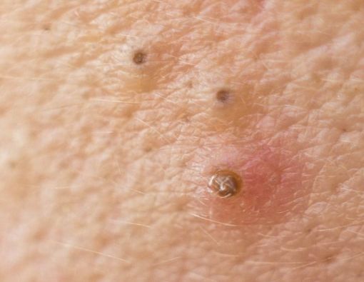 Menghilangkan Komedo dengan Skin Gritting, Efektifkah?