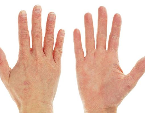 Osteoporosis dan Penyakit Eksim Berhubungan, Benarkah?