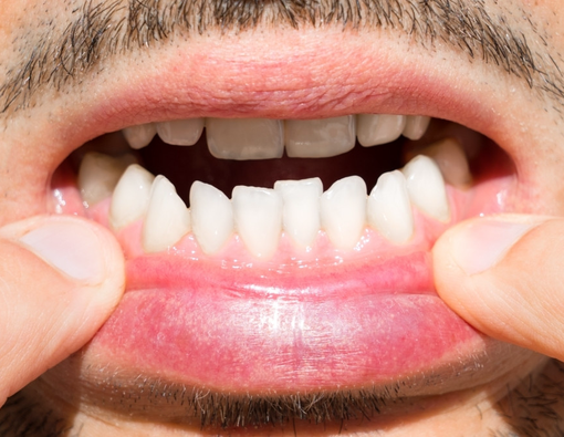 Gigi Goyang Picu Infeksi Jantung?