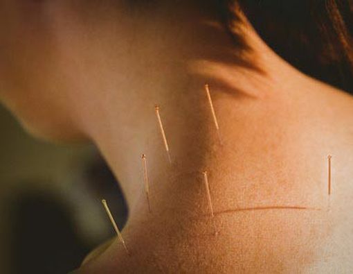 Akupunktur untuk Nyeri Leher