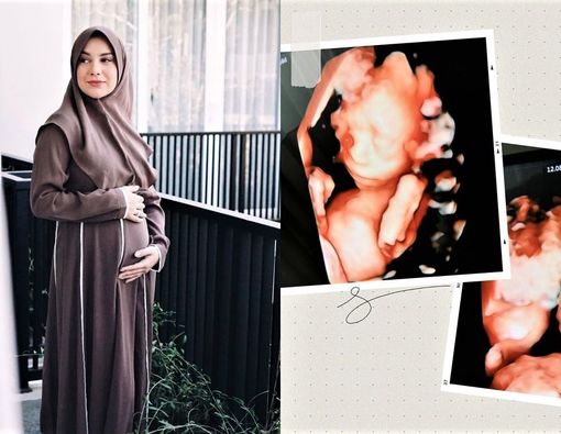 Sebelum Bayinya Meninggal, Ini 5 Masalah Kesehatan Irish Bella saat Hamil