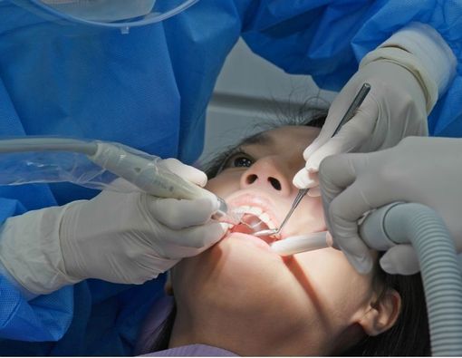 Mengenal Perbedaan Scaling dan Polishing Gigi