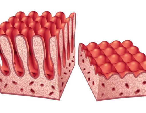 Sederet Bahaya Penyakit Celiac Terhadap Kesehatan Anak
