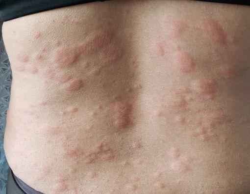 12 Cara Mengatasi Biduran Alami dan Tanpa Obat