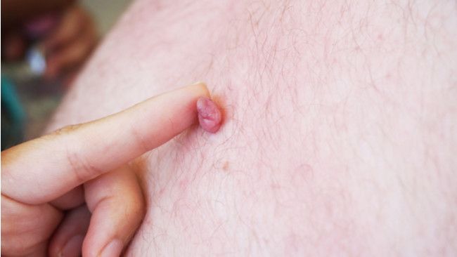 Penyebab Skin Tag dan Cara Efektif Menghilangkannya