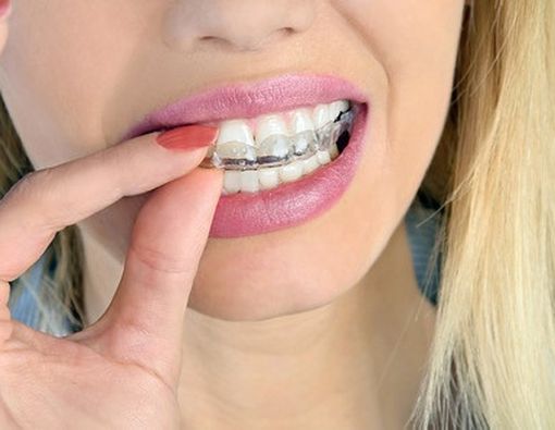 Memutihkan Gigi Sendiri di Rumah