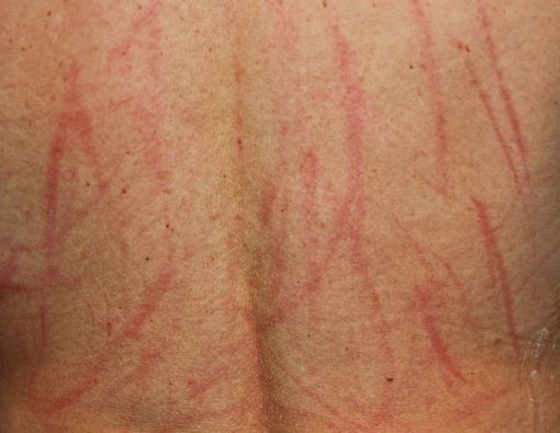 Cara Mengatasi Dermatografia, Kulit Rentan pada Goresan Kecil