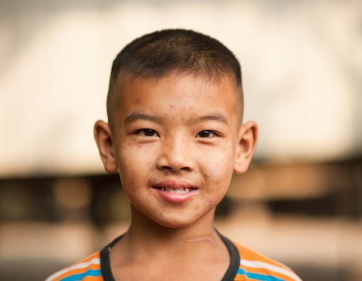 Kiat agar Tidak Muncul Bekas Cacar Air di Kulit