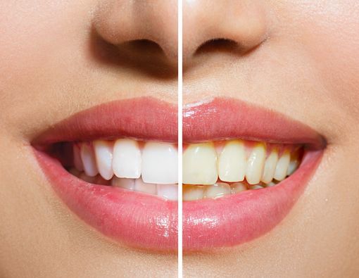 10 Cara Memutihkan Gigi Kuning secara Alami di Rumah