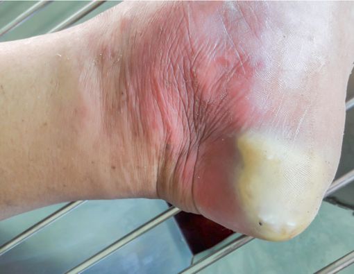 Kaki Diabetes, Komplikasi Diabetes yang Sering Terlupakan