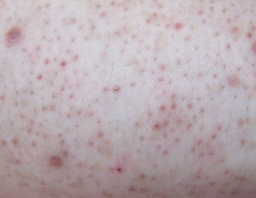 Keratosis Pilaris
