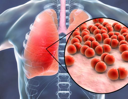 Pneumonia, Penyakit Paru yang Bisa Sebabkan Kematian