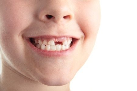 Gejala Penyakit Gigi yang Harus Diwaspadai