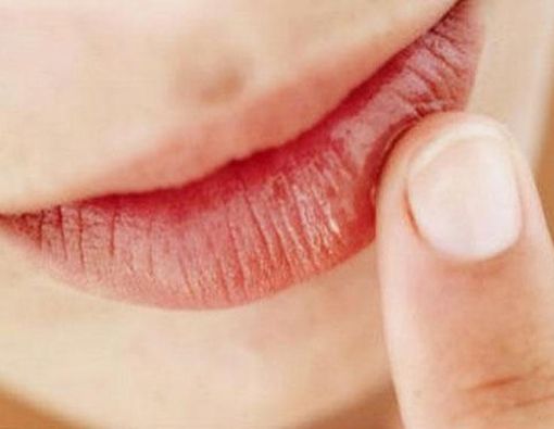 Intip 4 Penyebab Bibir Pecah-Pecah