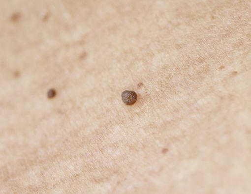 Cara Aman Menghilangkan Kutil di Kulit