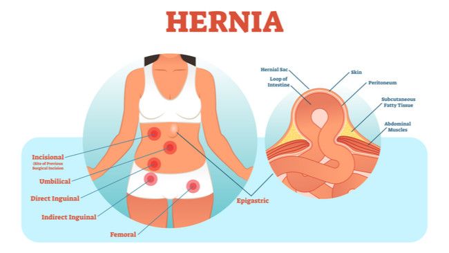 Mungkinkah Ibu Hamil Kena Hernia?