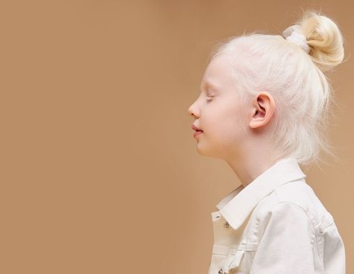 Cara Menjaga Kesehatan Mental Anak Albino