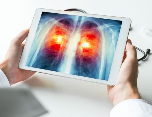 Apakah Kanker Paru-paru Bisa Menyerang Anak?