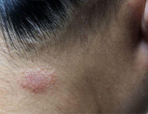 Panu Tak Kunjung Sembuh, Tanda Penyakit Apa?